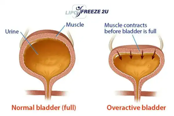 diagram of overactive bladder treatment Horley