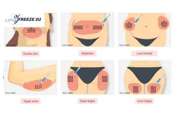 Benefits of Choosing Aqualyx for Fat Reduction Horley