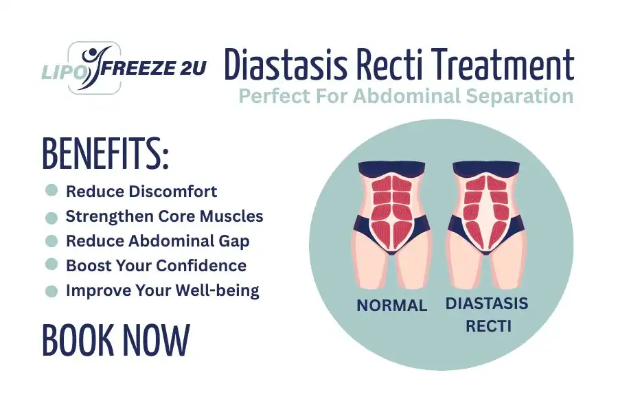Benefits of body toning treatment Horley for Diastasis recti