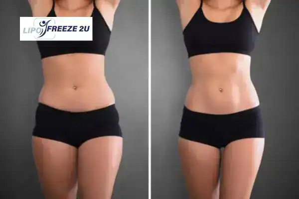 How Can LIPO FREEZE 2U Support Your Post-Pregnancy Body Recovery Horley?