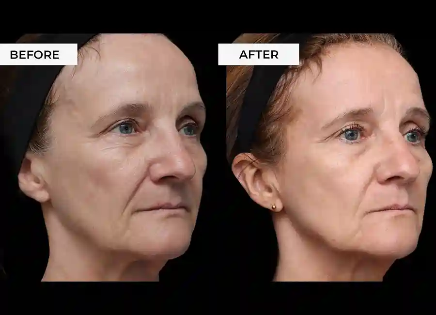 How Many RF Microneedling Sessions Will You Need to See a Difference Horley?