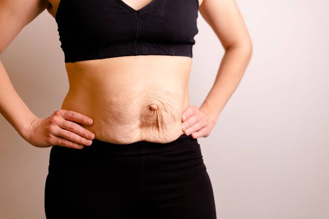 Is Surgery Really the Only Way to Repair Diastasis Recti Horley?