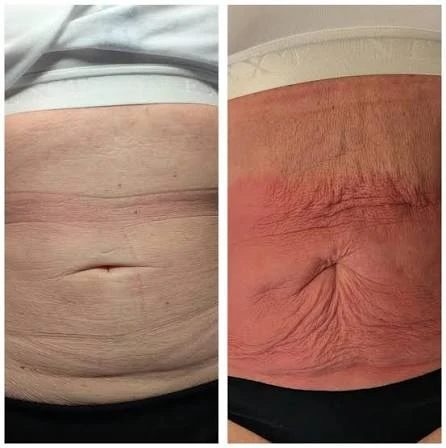 How Does RF Microneedling Improve Crepey, Thin and Uneven Skin Texture Horley?