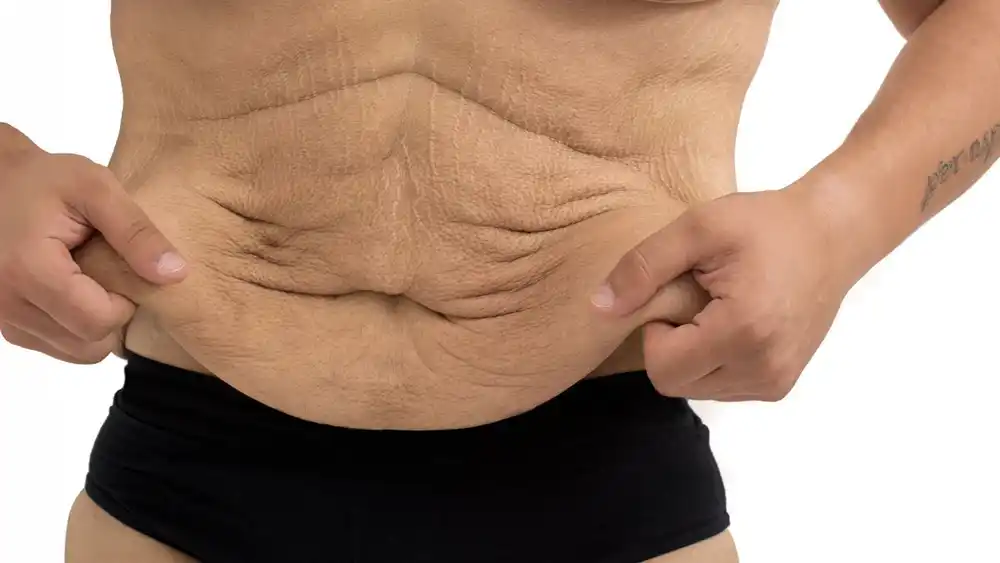RF Microneedling for Loose Skin: How Can It Help Tighten and Reshape the Skin Horley?